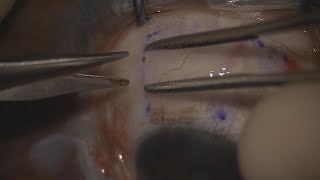 Pterygium Excision and Conjunctival Autografting