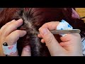 ASMR 🌟 Immersive Scalp Examination | Dandruff Cleaning | No Talking