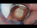 v5143 sealants and preventive resin restorations when u0026 how