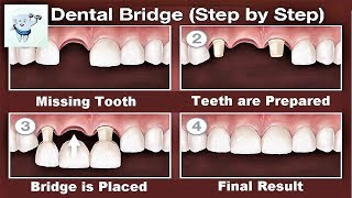 Dental Bridge Procedure Step by Step