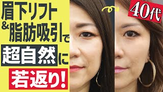 【パッチリ二重にしたい４６歳】それって眉下切開（眉下リフト）が適応かも！ハリのある目元が返ってきます♪