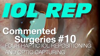 COMMENTED SURGERIES #10 - Four haptic IOL Repositioning and Optic Capturing