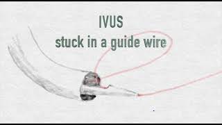 Angioplasty technique: Retrieve IVUS that is stuck with a wire　(+English subtitle)