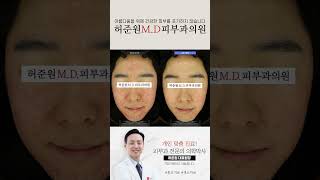 [압구정허준원엠디피부과] #안면홍조전문의 고민하지 말고 바로 이 곳, 허원장님에게로!!