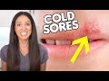 What are COLD SORES & How To Get Rid of Them