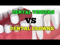 Dental Veneer vs Dental Crown