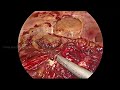 laparoscopic hydatid cyst