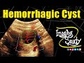 Ovarian Hemorrhagic Cyst | ORADS 2 || Ultrasound || Case 306