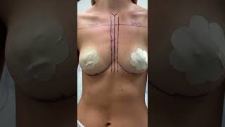 Breast Augmentation - From A to C with Immediate Before & After #breastaugmentationsurgery