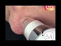 Blackhead Suction Extractor Vacuum by Just For Her Beauty Lab