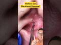 Worlds Most Satisfying EAR BLACKHEAD REMOVAL #shorts