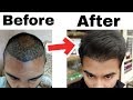 My 4 Months Hair Transplant Result Timeline || Best Hair Transplant Result In India