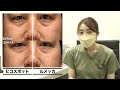 【よくわかる　ピコレーザー×ルメッカ 半顔症例解説】bianca clinic