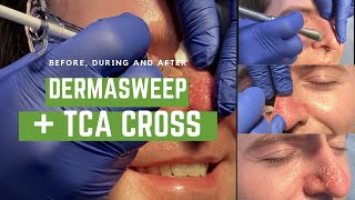 DermaSweep sucks sebum, TCA Cross attacks nose pore scars on guy