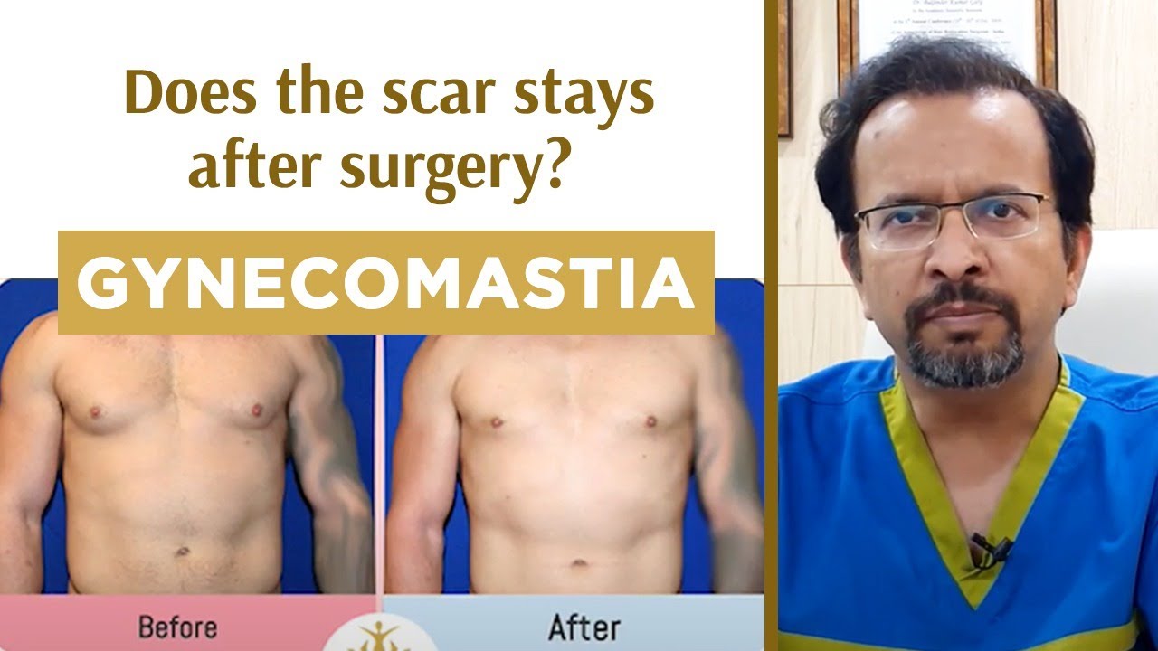 Does Gynecomastia Surgery Leave SCARS? |क्या छाती की सर्जरी में निशान ...