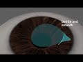 Eye laser correction: SmartSight lenticule extraction procedure with SCHWIND ATOS  femtosecond laser