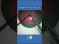 phaco soft lens training demonstration