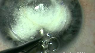 Pachy-Bubble Technique for Deep Anterior Lamellar Keratoplasty