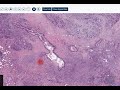 digital surgical pathology pancreas 2