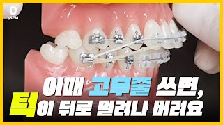 치아교정 고무줄 실패와 성공의 갈림길(재교정 위험, 2급 부정교합 고무줄,미니스크류)