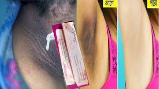 Skinshine এই ক্রিমটি ব্যবহার করলে মাত্র ১সপ্তাহে ঘাড় গলা ভগলের কালো দাগ দূর হবে|remove dark neck.