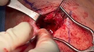 Reverse Total Shoulder Arthroplasty Replacement - Minimally Invasive