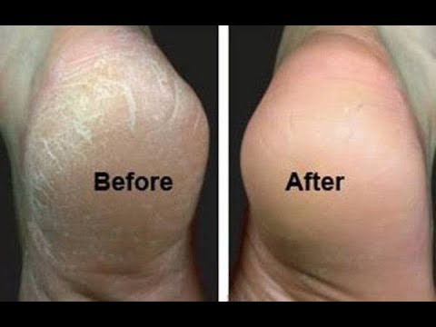 How to Get Rid of Cracked Heels in 3 Easy Steps | All About your Health How to Get Rid of Cracked Heels in 3 Easy Steps | All About your Health