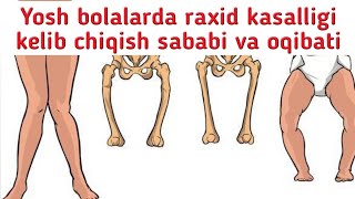 YOSH BOLALARDA Raxid kasalligini sababi va oqibatlari