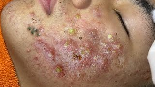 Big Cystic Acne Blackheads Extraction Blackheads \u0026 Milia, Whiteheads Removal Pimple Popping # 1691