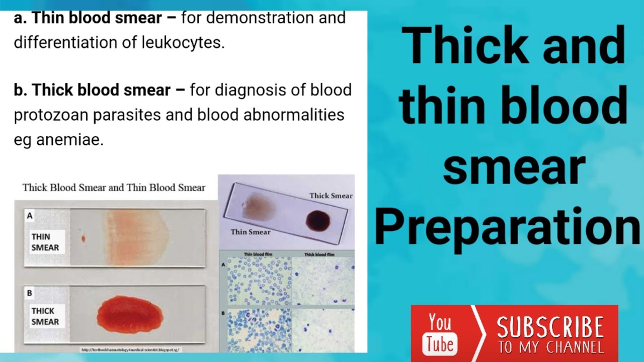 Thick And Thin Blood Smear Preparation - YouTube