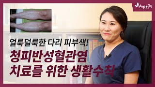 청피반성혈관염, 울혈반모양혈관염 환자들을 위한 생활 수칙