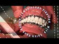 Intermaxillary Fixation with Erich Arch Bars