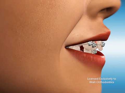 Can braces fix my teeth in 6 months?