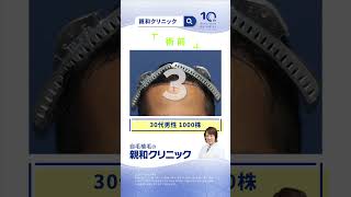 【AGA治療】生え際に1000株移植された体験者様へお話を伺いました。【自毛植毛】【植毛】#shorts