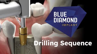 BLUEDIAMOND Implant Drilling Sequence