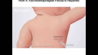 How A Tracheoesophageal Fistula Is Repaired