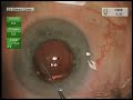 tecnis symfony intraocular lens iol implant u0026 femtosecond laser cataract surgery dr simon chen