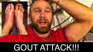 Gout Man Episode 5 - Oh No, I Have a Gout Attack!  What it's like having an acute gout flare up.