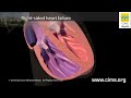 Heart Failure Overview | Dr Dhaval naik | Cardiac