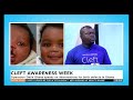 cleft awareness week operation smile ghana speaks on interventions for birth defects in ghana