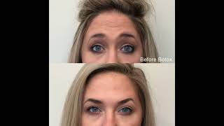 Before and After Botox at The Skin Center Pittsburgh Columbus