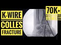 K- wire of Colles/ Distal Radius Fracture