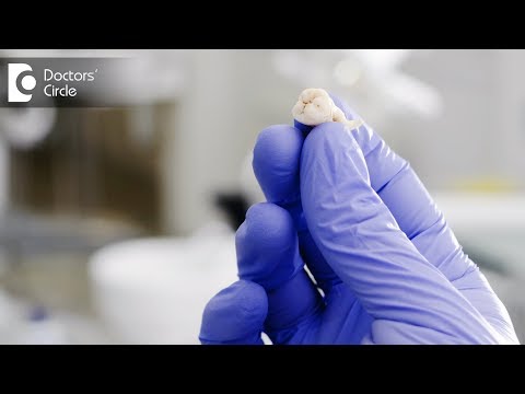 How long does it take to recover from wisdom teeth removal? - Dr. Neelum Ara How long does it take to recover from wisdom teeth removal? - Dr. Neelum Ara