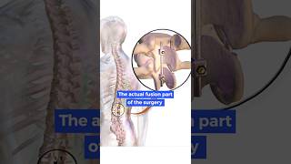 What happens in Spinal fusion surgery?