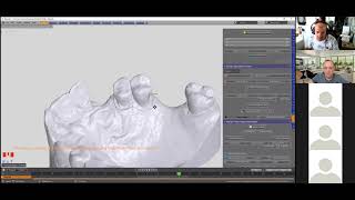 ZOOM- Making a Partial Denture