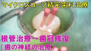 マイクロスコープを用いた精密歯科治療　②根管治療～コンポジットレジン修復（M.K様）