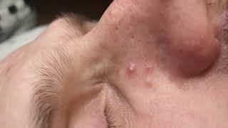 How to squeeze pimples at home?