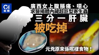 廣西女體內驚現超大寄生蟲　三分一肝臟被吃掉　只因生吃這種食物