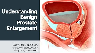 Understanding Benign Prostate Enlargement: A Comprehensive Guide
