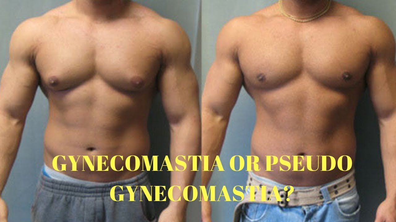 How To Tell If You Have Gynecomastia Or Pseudo Gynecomastia - YouTube